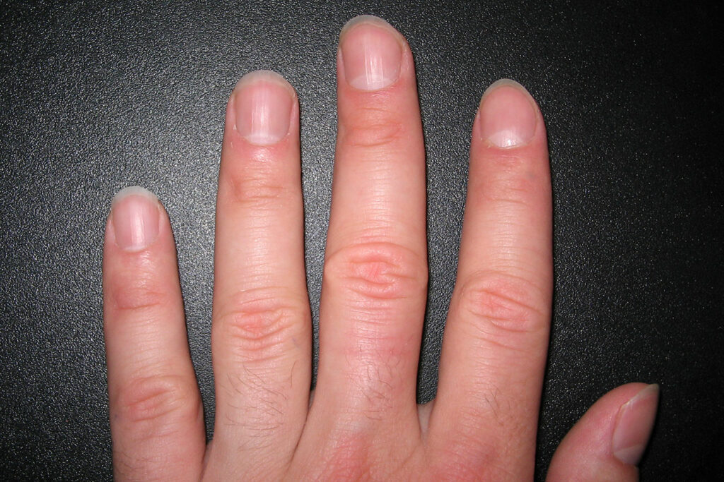 Die Lunula oder auch Nagelmond ist auf allen 5 Fingernägeln einer linken Hand deutlich sichtbar