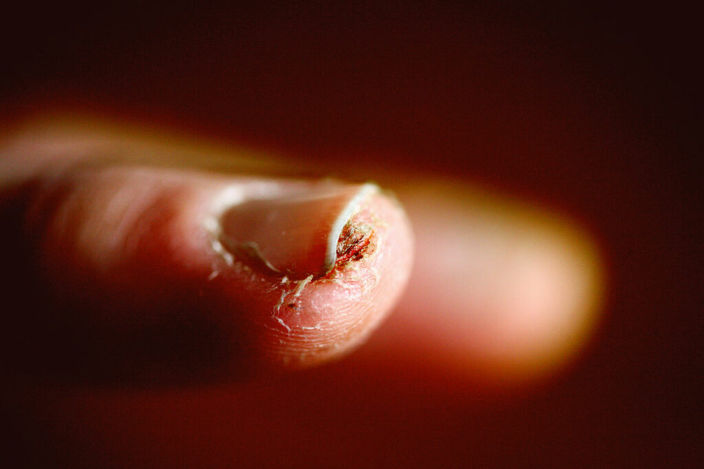 Ein Fingernagel, unter dem sich aufgrund einer Verletzung ein Ekzem oder auch Pilz gebildet hat